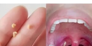 Understanding Tonsil Stones: Causes of the Smell and Effective Ways to Treat Them