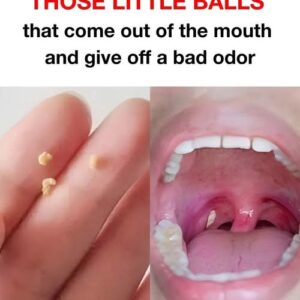 Understanding Tonsil Stones: Causes of the Smell and Effective Ways to Treat Them