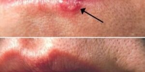 Most People Have Had or Have This Cold…