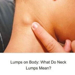 What Do Neck Lumps Mean?