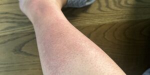 I’m 18 weeks pregnant and got this horrible rash on my legs. Itchy and bumpy skin. Can’t get an OB appt quickly. What can I do for relief?