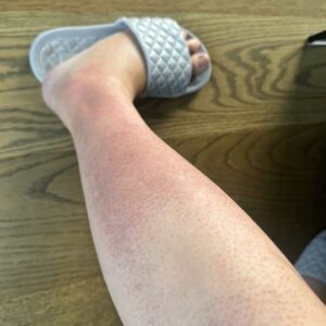 I’m 18 weeks pregnant and got this horrible rash on my legs. Itchy and bumpy skin. Can’t get an OB appt quickly. What can I do for relief?