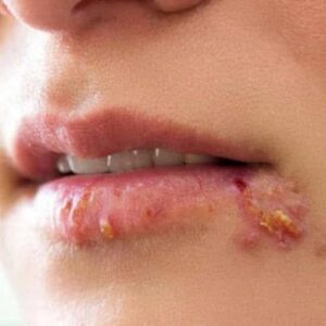 Cold sore? Eliminate it with these remedies