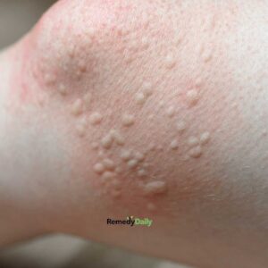 Got these raised bumps near my knees. Doctor’s appt is far away. What should I do? What is it?