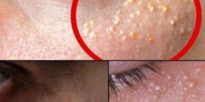 White Bumps on the Skin: Causes, Natural Solution, and Practical Tips