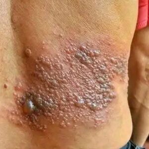It was itching his body, he thought it was an allergy, but a tough diagnosis… See more