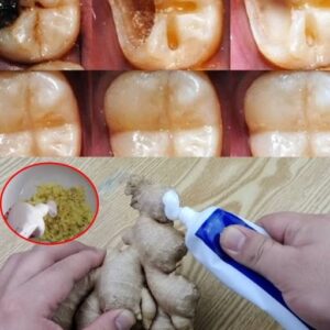 How to Naturally Repair a Cavity & Strengthen Your Teeth