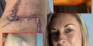 Mom Gets 77 Stitches in Arm After She Ignores a ‘Normal’ Mole