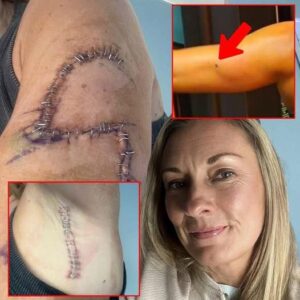 Mom Gets 77 Stitches in Arm After She Ignores a ‘Normal’ Mole
