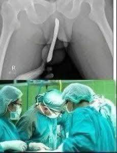 😱Girl was hospitalized for trying one more pen…See more