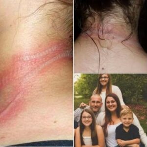 13-year-old girl left with horrific burns on her neck after using her cellphone while it was charging