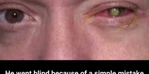 The Nightly Habit That Cost a Man His Sight: A Cautionary Tale for Contact Lens Users