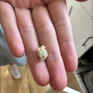 Here’s what you need to know about tonsil stones