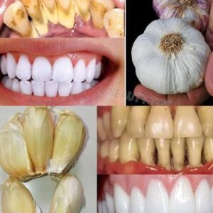 Improve Your Oral Health Naturally with Garlic