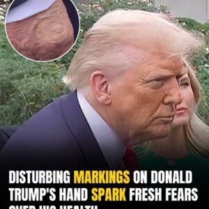 Concerning Marks On Trump’s Hand? Experts Reveal What They Really Are
