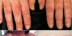 HT9. Red, Itchy, and Sweaty Skin are the consequences of having s… See more