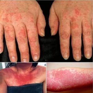 HT9. Red, Itchy, and Sweaty Skin are the consequences of having s… See more