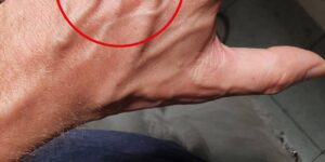 When should you be concerned about suddenly appearing veins?