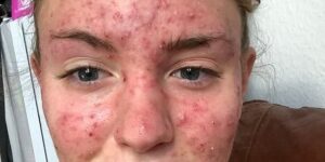 Her body was itching, I thought it was an allergy, they diagnosed ca… see more
