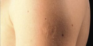 Smallpox vaccine scars: What they look like and why