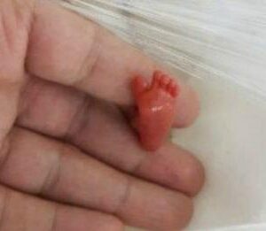 Baby Who Was Born 12 Weeks Early Sets Record For Smallest Infant To Ever Survive