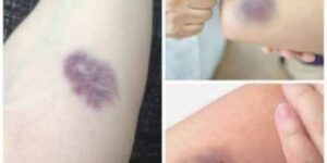 BE CAREFUL, if you get these bruises on your body, it means you have