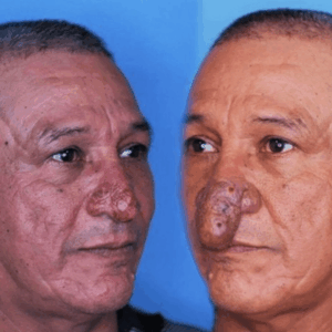 The Remarkable Transformation of Conrado’s Nose