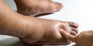 These are the first symptoms of cr …. See more