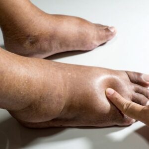These are the first symptoms of cr …. See more