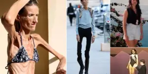 The World’s Thinnest Woman’s Battle Against Anorexia Will Leave You Speechless!
