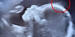 Doctors couldn’t believe what they saw during the ultrasound