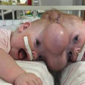 Conjoined twins Abby and Erin Delaney: Inside their remarkable story