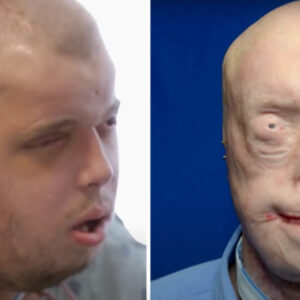 Patrick Hardison received a new face after third-degree burns, this is him today